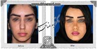 عمل بینی شماره 1033