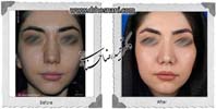 عمل بینی شماره 1036گوشتی با غضروف های قوی