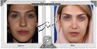 عمل بینی شماره 1037گوشتی