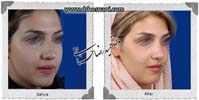 عمل بینی شماره 1038گوشتی