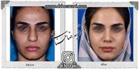 عمل بینی شماره 1041گوشتی