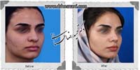 عمل بینی شماره 1042گوشتی