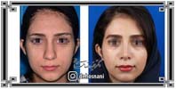 عمل بینی شماره 1043غضروفی با پوست ضخیم