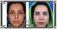 عمل بینی شماره 1045