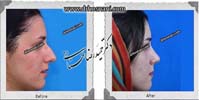 عمل بینی شماره 1052