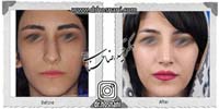 عمل بینی شماره 1053