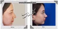 عمل بینی شماره 1058