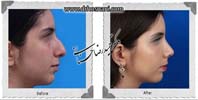 عمل بینی شماره 1060