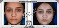  جراحی بینی -1063