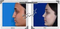  جراحی بینی -1064