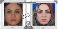 عمل بینی شماره 1065گوشتی