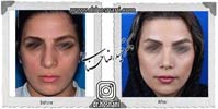 عمل بینی شماره 1067غضروفی (استخوانی)