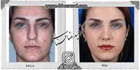 عمل بینی شماره 1069