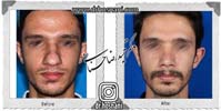 عمل بینی شماره 1071
