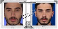عمل بینی شماره 1075