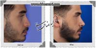 عمل بینی شماره 1076