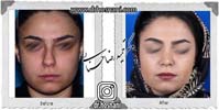 عمل بینی شماره 1079