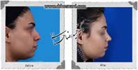 عمل بینی شماره 1080