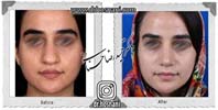 عمل بینی شماره 1083