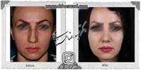 عمل بینی شماره 1085