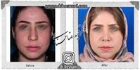 عمل بینی شماره 1089