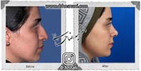 عمل بینی شماره 1093