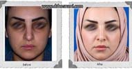 عمل بینی شماره 1095