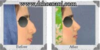  جراحی بینی -11