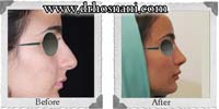  جراحی بینی -118