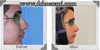  جراحی بینی -148