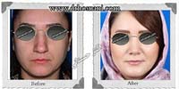  جراحی بینی -192