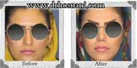عمل بینی شماره 20