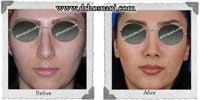 عمل بینی شماره 206غضروفی با پوست ضخیم
