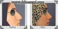 عمل بینی شماره 22غضروفی با پوست ضخیم