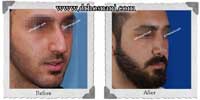 عمل بینی شماره 265غضروفی با پوست ضخیم