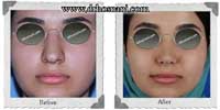 عمل بینی شماره 267غضروفی با پوست ضخیم