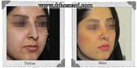 عمل بینی شماره 269غضروفی با پوست ضخیم