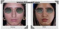 عمل بینی شماره 291غضروفی با پوست ضخیم