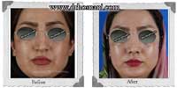 عمل بینی شماره 322غضروفی با پوست ضخیم