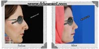  جراحی بینی -338