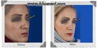  جراحی بینی -339