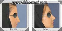  جراحی بینی -34