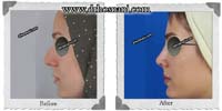  جراحی بینی -343
