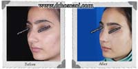 عمل بینی شماره 365غضروفی با پوست ضخیم