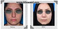  جراحی بینی -401