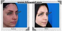  جراحی بینی -402