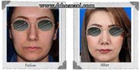 عمل بینی شماره 405گوشتی با غضروف های قوی