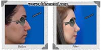  جراحی بینی -406