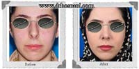 عمل بینی شماره 407غضروفی (استخوانی)