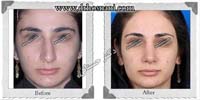 عمل بینی شماره 426غضروفی با پوست ضخیم